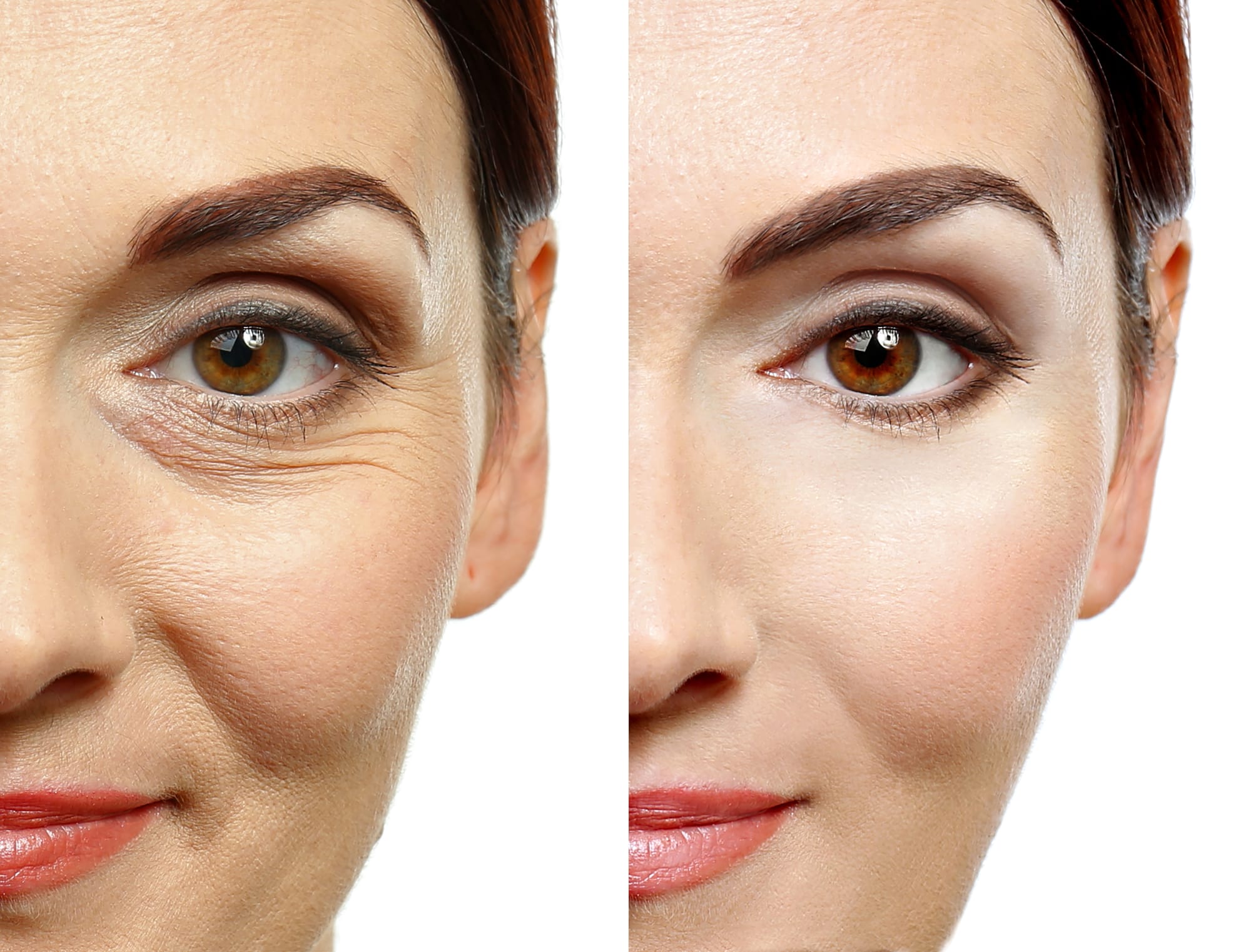 under eye wrinkle remover